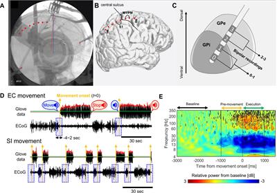 Altered Pallidocortical Low-Beta Oscillations During Self-Initiated Movements in Parkinson Disease